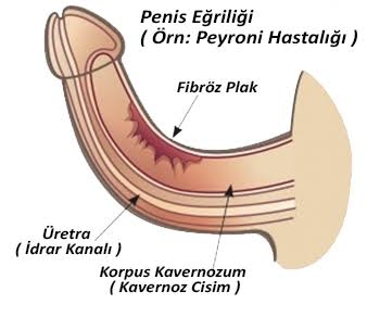 Peyronie Hastalığı