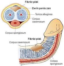 Peyronie Plağı Tedavisi