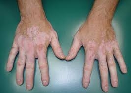 Vitiligo Sebepleri Nelerdir ?