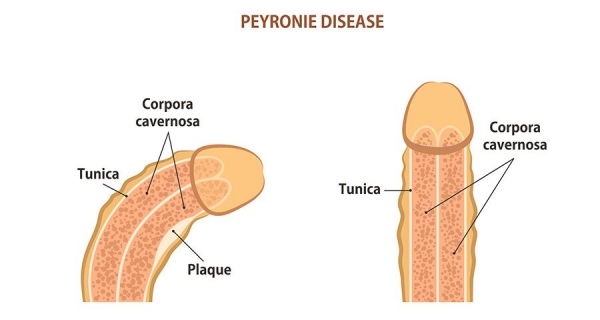 Penis Eğriliği Nedir